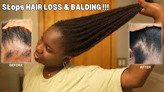 Use This Once a Week and Your Hair Will Never Stop Growing DIY for HAIR LOSS amp BALDING‼️ [upl. by Ainud]