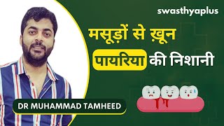 मसूड़ों से ख़ून क्या है इलाज  Treatment of Pyorrhea in Hindi  Dr Muhammad Tamheed [upl. by Sliwa]