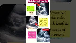 Echo of Normal Aortic stenosis and post AVR l इको टेस्ट echo aorticvalve shorts [upl. by Akirderf]