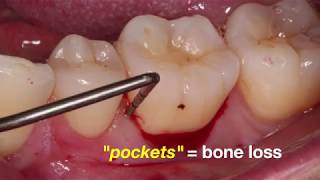 Rebuilding bone around a tooth using laser and Emdogain by Dr Jin Kim [upl. by Sams541]