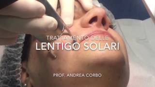 Lentigo Solari  Trattamento con Laser frazionato CO2 [upl. by Arrat536]