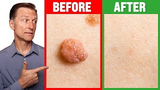 How to Rid Skin Tags and Warts Within 24 Hours  Dr Berg on Skin Tag Removal [upl. by Holofernes]