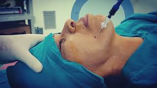 Trigeminal neuralgia radiofrequency ablation therapy [upl. by Matthias732]