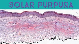 Solar purpura bruising on arms hands of elderly due to sun damagepathology dermpath dermatology [upl. by Assilev409]