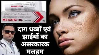 Melalite XL Ointment for melasma। Metacortil ointment review Hydroquinone Tretinoin amp Mometasone [upl. by Bowe]