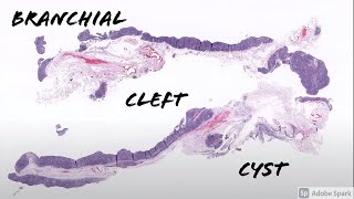 Branchial Cleft Cyst 5Minute Pathology Pearls [upl. by Muryh762]