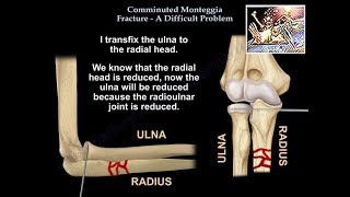 Comminuted Monteggia Fracture Difficult Problem  Everything You Need To Know  Dr Nabil Ebraheim [upl. by Aznofla]