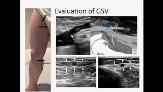 Ultrasound Evaluation of Lower Limb Superficial Veins  Subasit Acharji MD [upl. by Messab286]