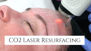 CO2 Laser Facial Rejuvenation  Fix Fine Lines and Wrinkles  Fix Sun Damage  Fix Stretch Marks [upl. by Aicaca]