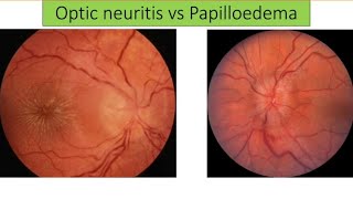 Lacture  Optic neuritis vs Papilloedema [upl. by Adaynek]