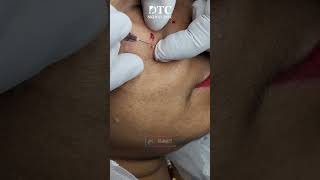 Milia Extraction Procedure  DTC Skin Clinic [upl. by Riane]