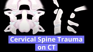 Cervical Spine Trauma on CT [upl. by Ahsenal590]