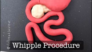 Playdough Surgery 🔪🍐  PylorusPreserving Pancreaticoduodenectomy AKA Whipple Procedure  Part I [upl. by Anairb]