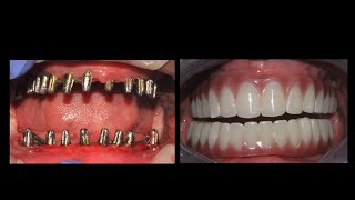 How to make Amazing implant Bridge with BREDENT gum color for durable prosthesis [upl. by Eirhtug916]