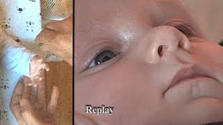 Baby – Palmomental reflex PMR [upl. by Gallagher]