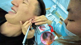 Intense Chinese Earwax Removal 🇨🇳 [upl. by Oca]