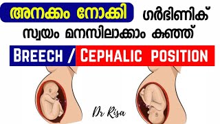 Cephalic vs Breech Baby Movement  Baby Head Down Symptoms Pregnancy Baby Movement [upl. by Behnken741]