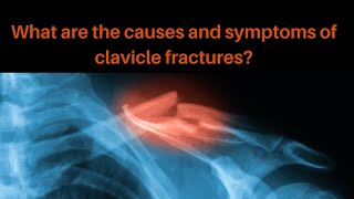 What are the common causes and symptoms of a clavicle fracture [upl. by Fredela593]