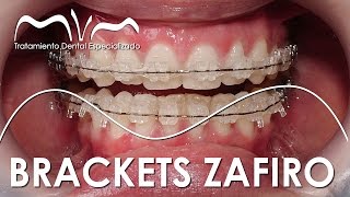 TODO SOBRE LOS BRACKETS ZAFIRO  ¿YA TE DECIDISTE [upl. by Anerres562]