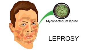 Leprosy Hansens disease Symptoms Treatment andPrevalence [upl. by Lucic]