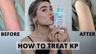 HOW TO GET RID OF KP ON ARMS  KERATOSIS PILARIS [upl. by Bedell]