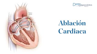 Ablación cardiaca  Doctores Especialistas [upl. by Enaht525]