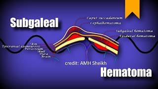 Subgaleal Hematoma [upl. by Rutherford855]