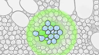 Radium223 and Metastatic Prostate Cancer [upl. by Doti]