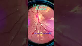 Peripapillary atrophy  Smartphone Fundus Videography  Fundus Photography  Short Video 74 [upl. by Skippy18]