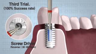 KIT RIMOZIONE IMPIANTI ABUTMENTS amp VITI PROTESICHE [upl. by Baskett]