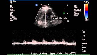 Duplex Demonstration of Normal Renal Arterial Blood Flow  Case Study [upl. by Mackler802]