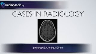 Radiology of Spine Trauma [upl. by Leach]