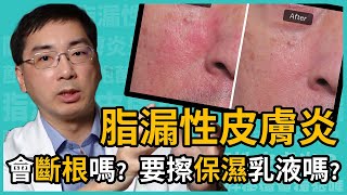 脂漏性皮膚炎會斷根嗎？需擦保濕乳液嗎？皮膚科林政賢醫師完整保養教學一次告訴你！ [upl. by Aitetel866]