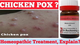 चिकन पॉक्स केलिये होम्योपैथीHow to cure CHICKEN POX Homeopathic Medicine MALANDRINUM 4CHICKEN POX [upl. by Emya]