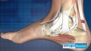 Ankle Joint ArthroscopyTherapeutic  Ankle Arthroscopic Surgery Examination Treatment [upl. by Accemahs]