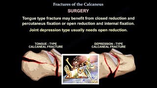 Fractures Of The Calcaneus  Everything You Need To Know  Dr Nabil Ebraheim [upl. by Neirbo282]