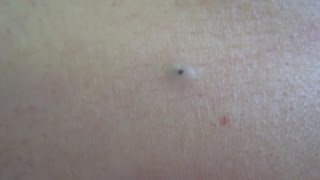 Dilated Pore Treatment [upl. by Oneida]