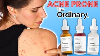 3 Best Acne Products From The Ordinary  For Blemish amp Breakout Prone Skin [upl. by Asirap98]