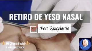 Retiro de yeso ó férula nasal  Rinoplastia [upl. by Ellenet]