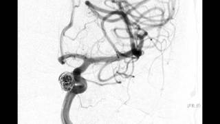 Neurointerventional Stroke Rounds  Aneurysm Coiling [upl. by Lurleen]