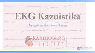 Kardioblog  EKG Kazuistika Asymptomatická bradykardie [upl. by Tilney]