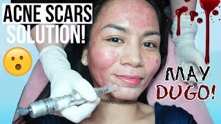 Flawless MICRO NEEDLING TREATMENT for ACNE SCARS Sugugatin Para Gumaling [upl. by Asiat79]