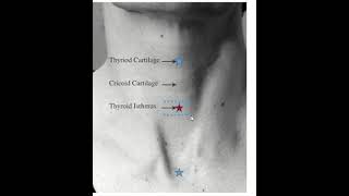 Living anatomy of Isthmus of thyroid gland [upl. by Tichonn]