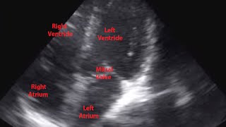 Echocardiogram of Premature Ventricular Contraction  Loop [upl. by Frankhouse809]