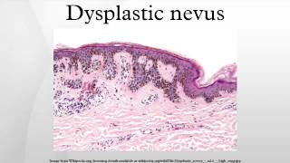 Dysplastic nevus [upl. by Baxter]