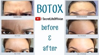 BOTOX BEFORE amp AFTER [upl. by Tenay736]