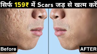 Acne Scars के 3 Treatment  How To Remove Pimples Holes Scars Hindi [upl. by Singband]