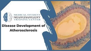 Disease Development of Atherosclerosis [upl. by Lenor511]