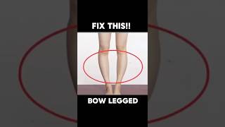 Exercise for BOW LEGGED ✅👍 bowlegs shortsfeed shortsvideo [upl. by Neroc]