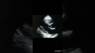 echocardiography echocardiographer echo video  case 15 [upl. by Aehtna]